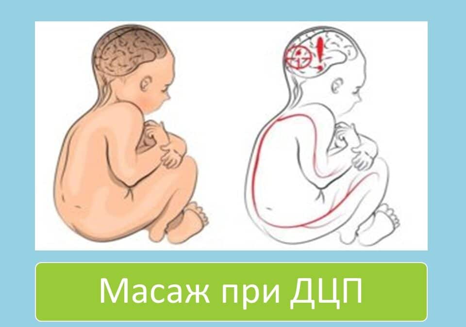 Масаж при дитячому церебральному паралічі (ДЦП)