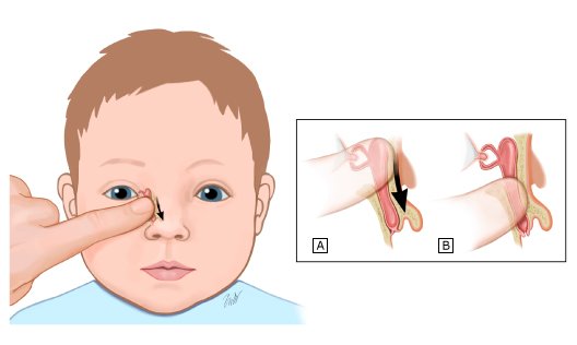 Масаж слізного каналу у немовлят: як правильно робити та що слід знати